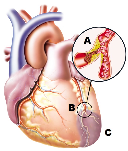 desen anatomic al inimii cu un vas de sânge blocat