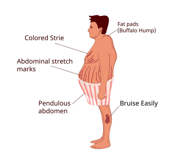 Sindromul Cushing