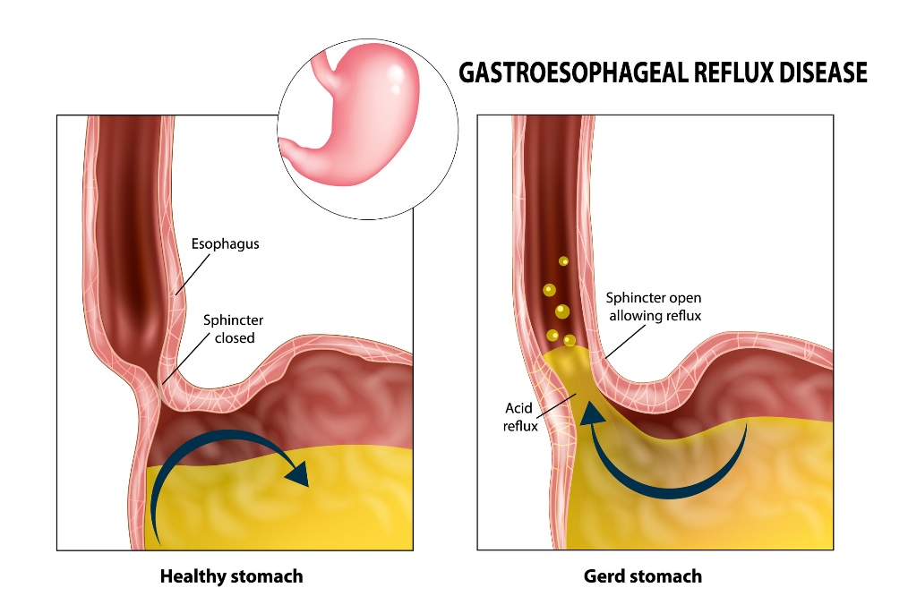 Reflux gastroesofagian: esofag, sfincter, stomac și acid gastric