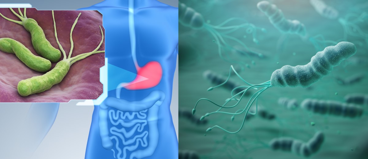 Helicobacter pylori colonizează mucoasa stomacului și este un factor de risc pentru gastrită, ulcer și cancer.