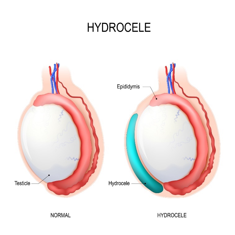 Hidrocel: testicul, epididim, Hidrocel (lichid acumulat)