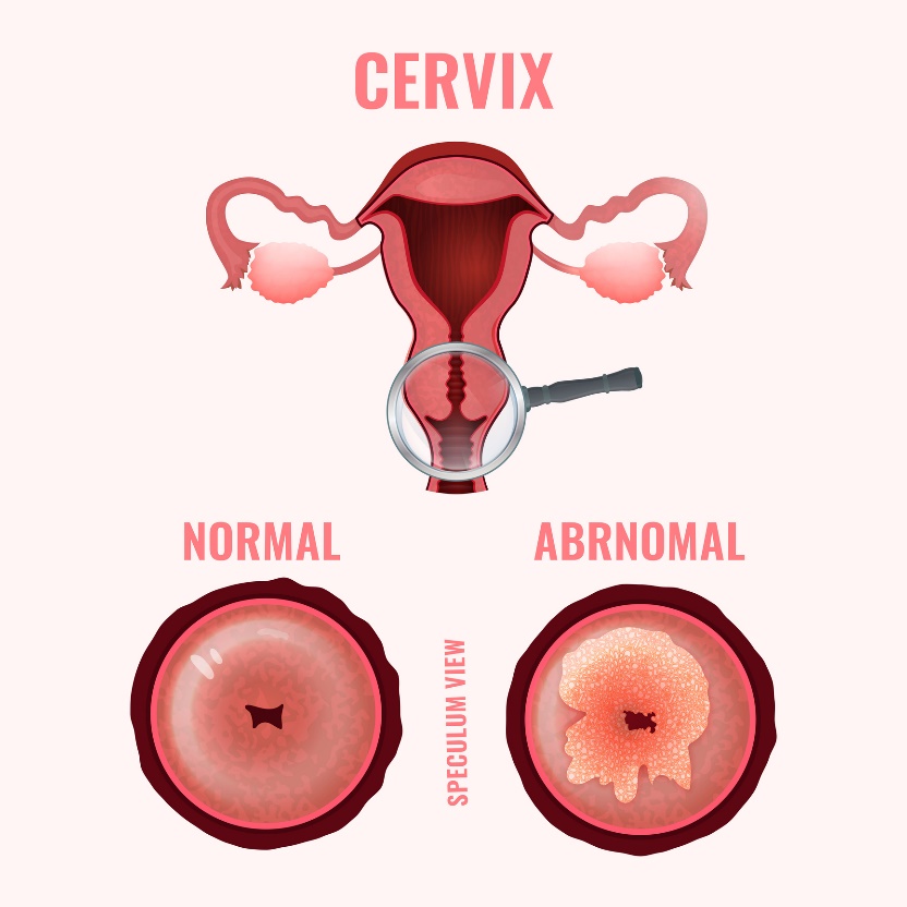 Crampe uterine