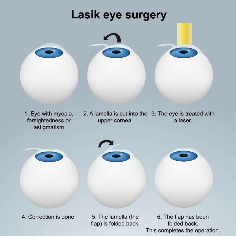 Operația cu laser pentru ochi LASIK - metoda subsuprafață. Procedeu cu lambou/lap fără a deteriora terminațiile nervoase.