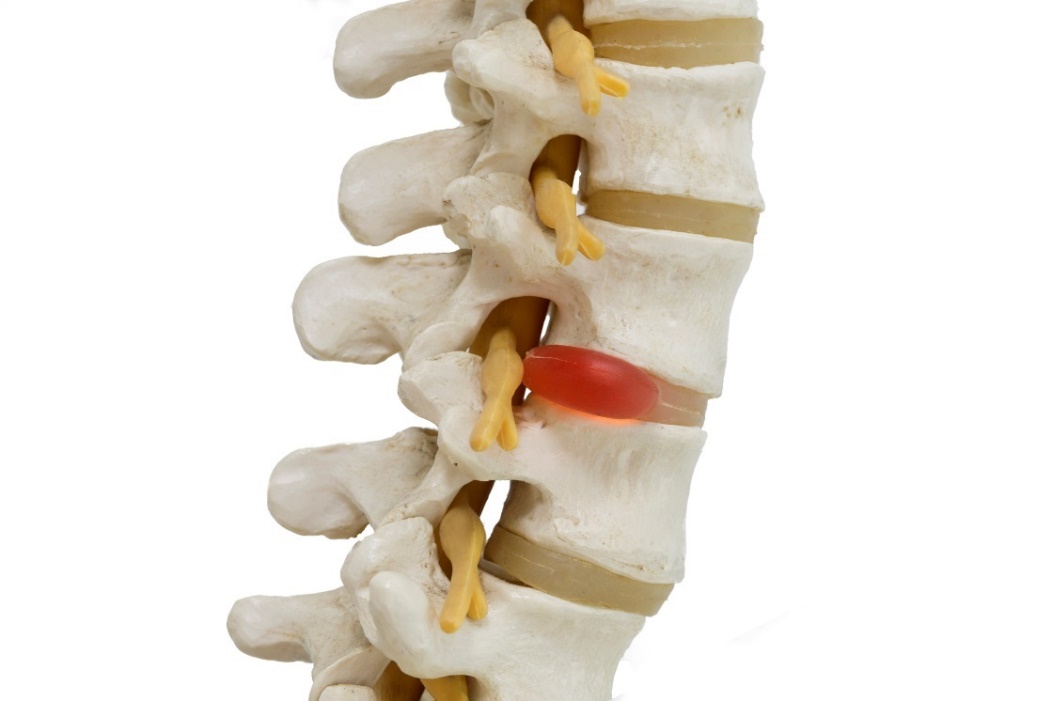 Reprezentarea anatomică a unui model 3D al coloanei vertebrale, a discurilor intervertebrale și a herniei de disc cu compresie nervoasă