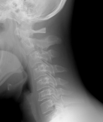 Radiografie a coloanei vertebrale cervicale