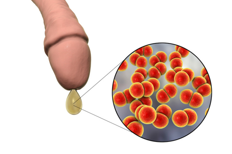 durere a penisului cu descărcare și bacterii microscopice de gonoree