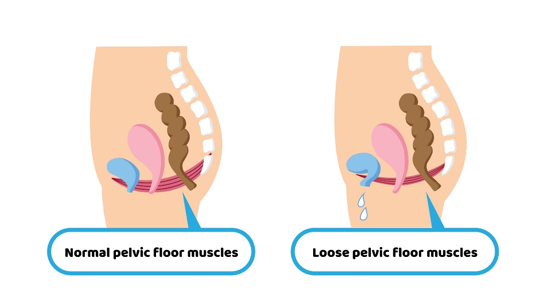 Starea fiziologică a musculaturii planșeului pelvian și starea permisivă a musculaturii planșeului pelvian care duce la incontinență