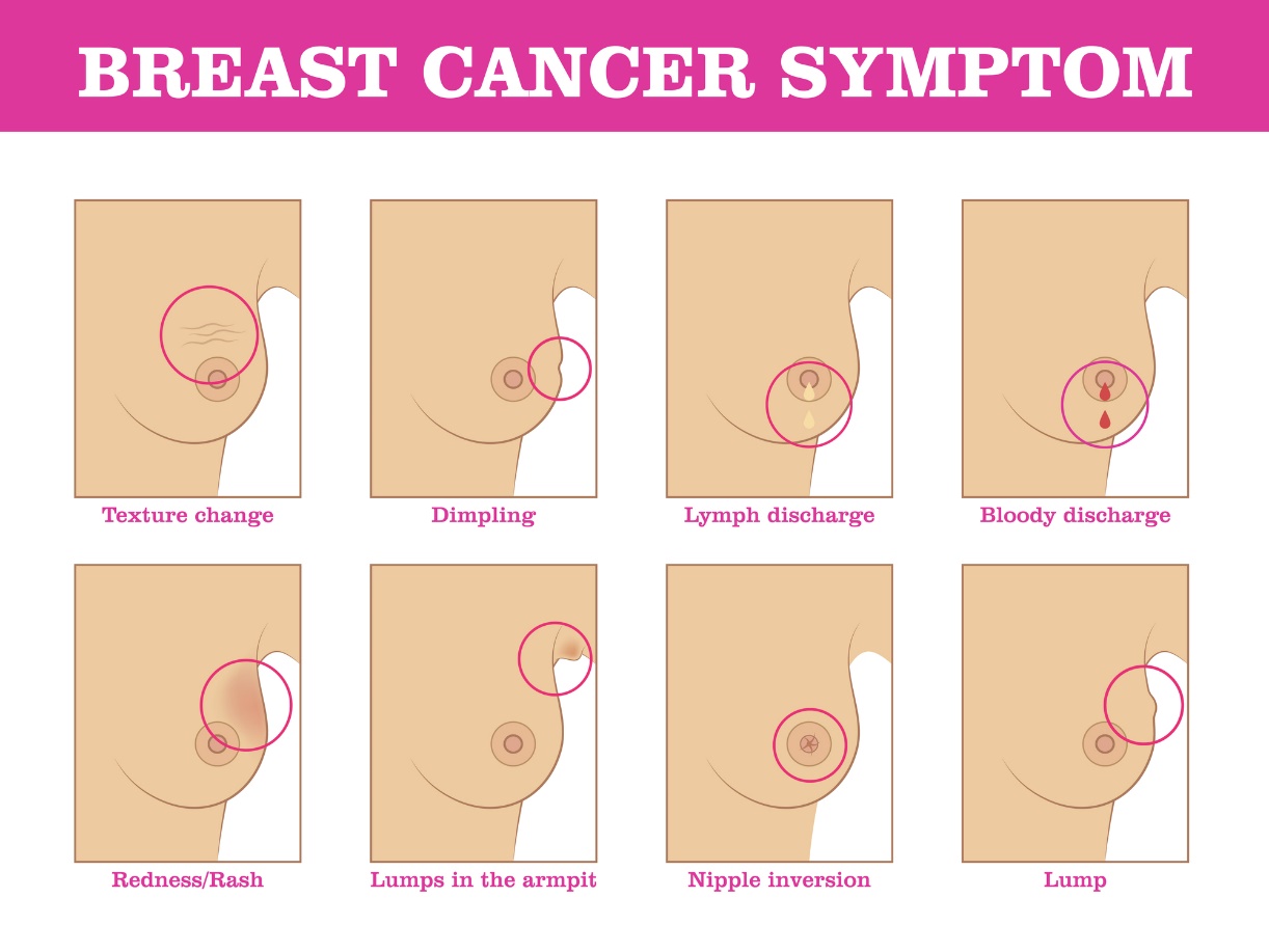 Simptomele cancerului de sân: schimbarea structurii sânului, schimbarea culorii și a suprafeței sânului, secreții și retracția mamelonului, localizarea nodulului.