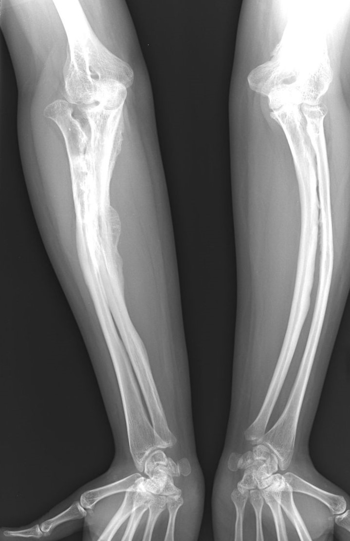 Radiografii ale bolii osteogenezei imperfecta la un adult