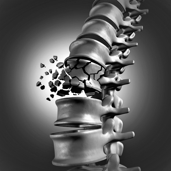 Fractura vertebrală a coloanei vertebrale