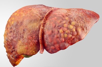 Ciroza hepatică