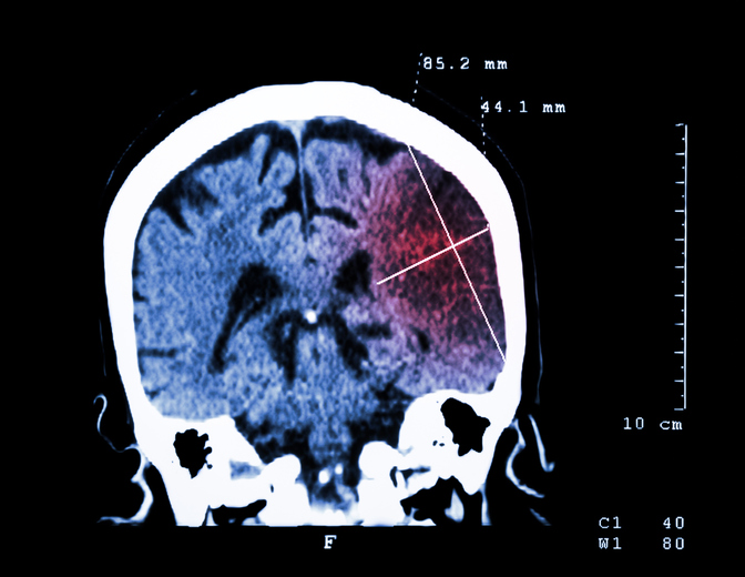 Leziuni cerebrale vizibile la tomografie computerizată