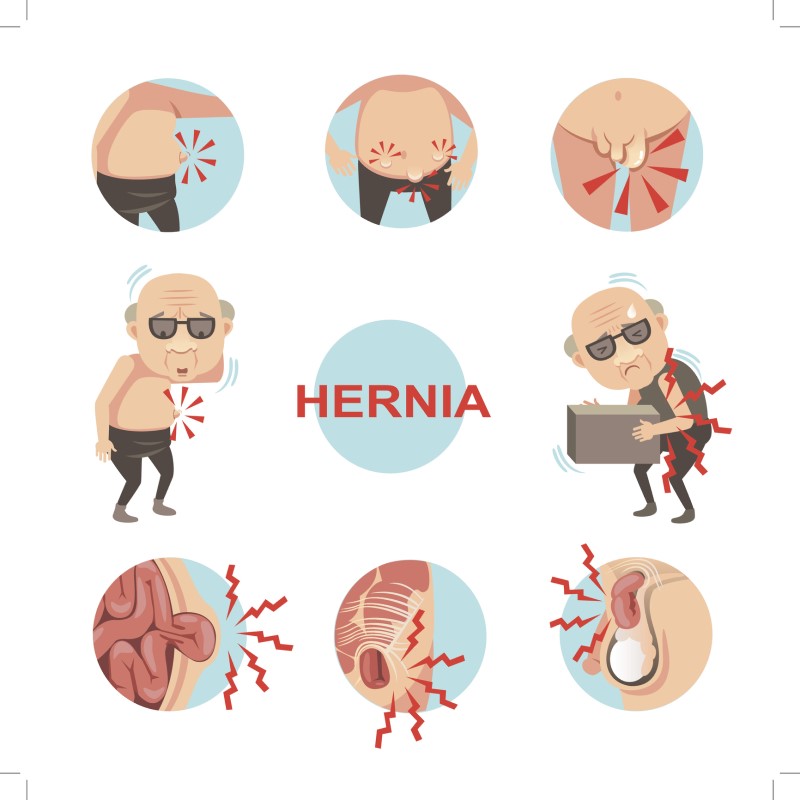 Hernia - model de simptom