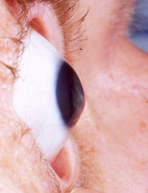 Keratoconus, degenerare a corneei