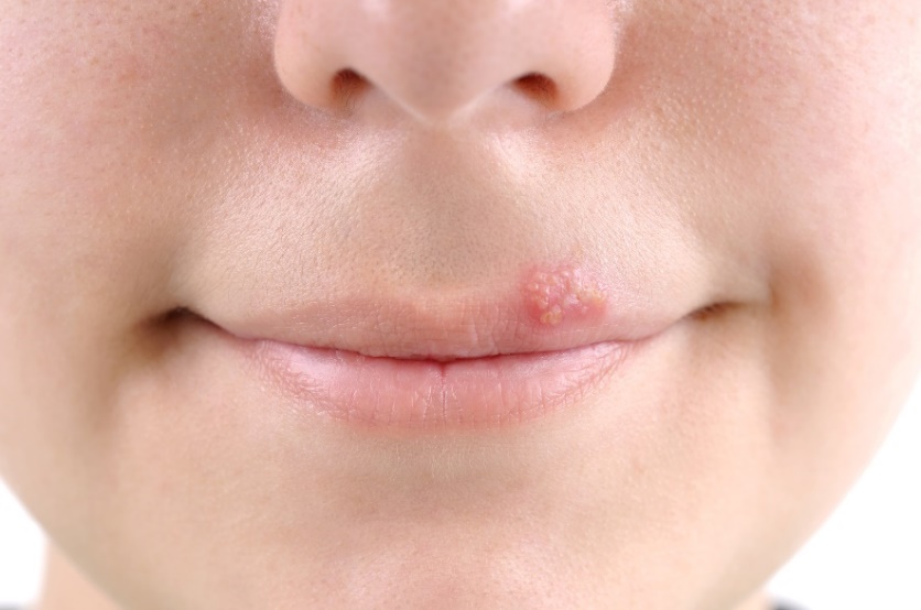 Bășici - herpes labial (herpes) în jurul mucoasei gurii.