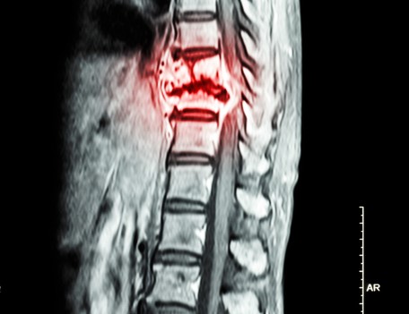 Radiografie a coloanei vertebrale toracice cu dovezi de cancer la nivelul coloanei vertebrale toracice