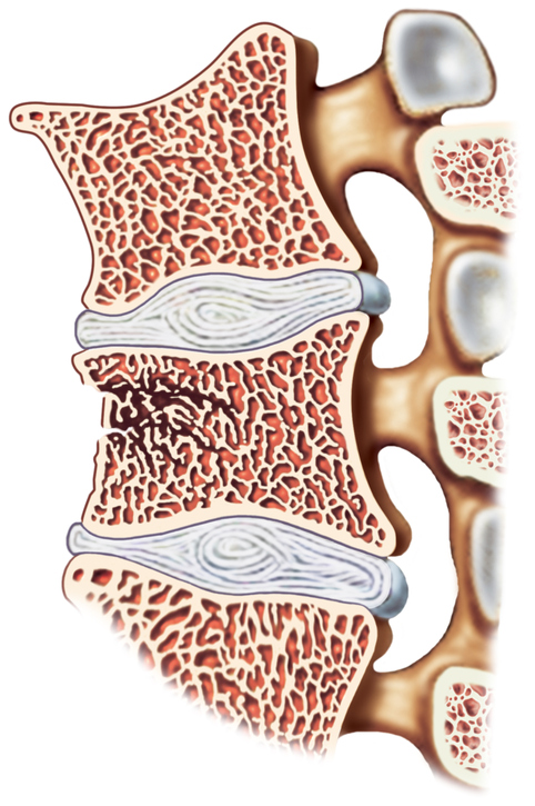 coloana vertebrală, reprezentarea vertebrelor și a discurilor intervertebrale, fractură vertebrală