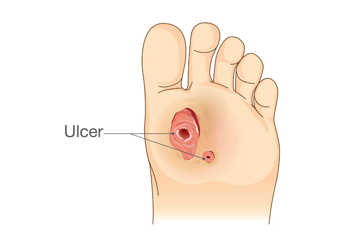 Ulcer pe picior