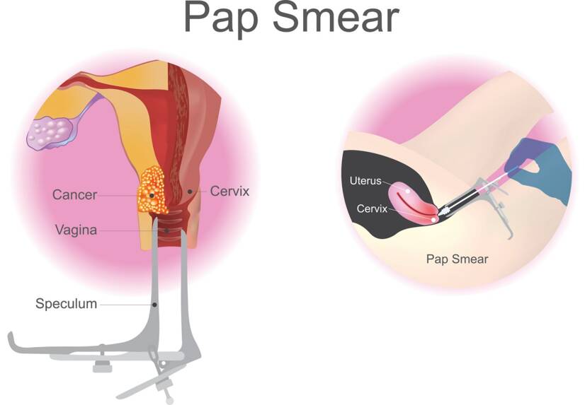 Examinare de screening, frotiu cervical. Sursa: Getty Images