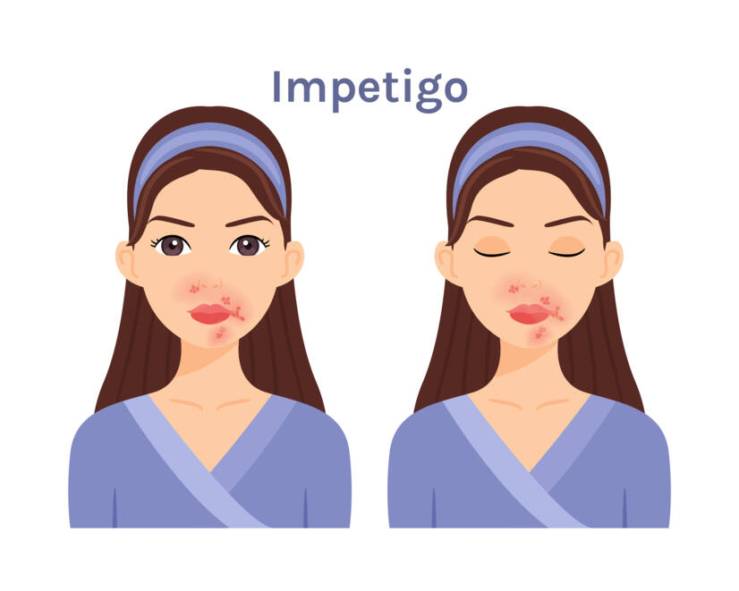 Ce este impetigo, ce simptome are? Infecțiozitatea și transmiterea la copii