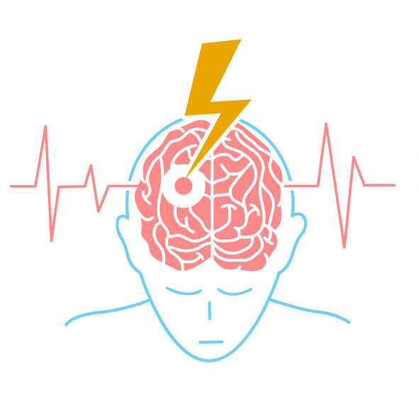 Ce este un accident vascular cerebral? Cunoașteți simptomele, riscurile și tratamentul?