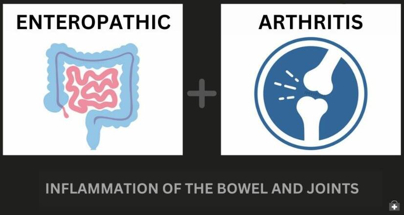 Artrita enteropatică și boala inflamatorie intestinală: cum sunt ele legate + Simptomele