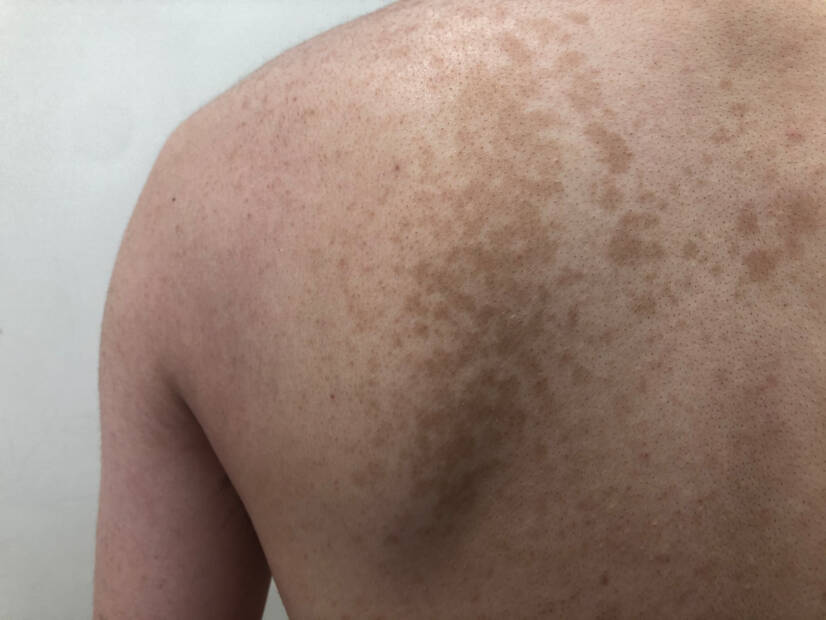 Pityriasis versicolor: Ce este și ce simptome are? Cauze și transmitere