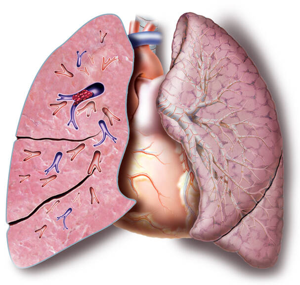 Embolia pulmonară: de ce apare, cum se manifestă, cum este detectată și tratată?