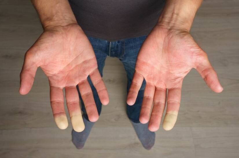 Sindromul Raynaud: care este cauza amorțelii degetelor?