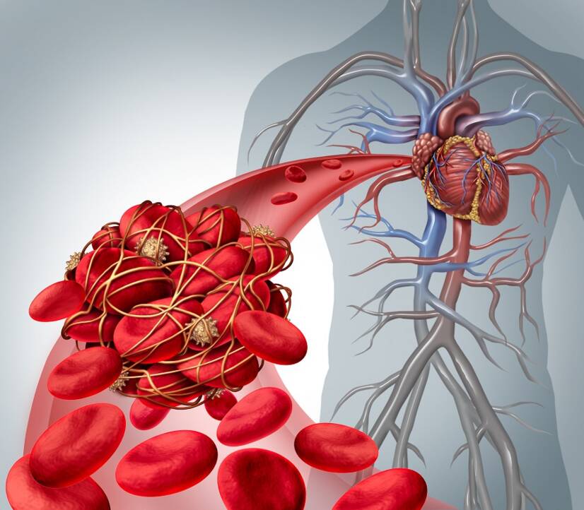 Boala tromboembolică, de ce apare, cum este legată de embolia pulmonară?