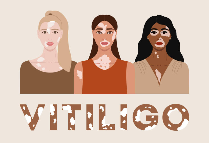 Vitiligo: Ce este vitiligo și care sunt cauzele și simptomele sale? Când începe?