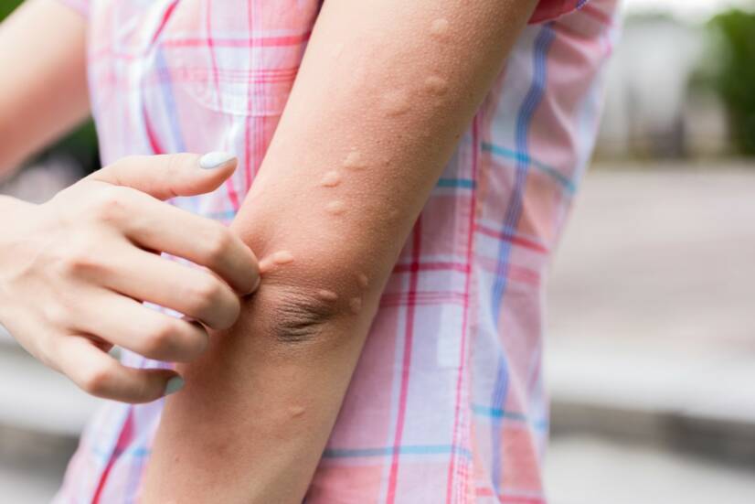 Urticaria: Urticaria nu numai după o arsură de urzică? Înseamnă o boală?