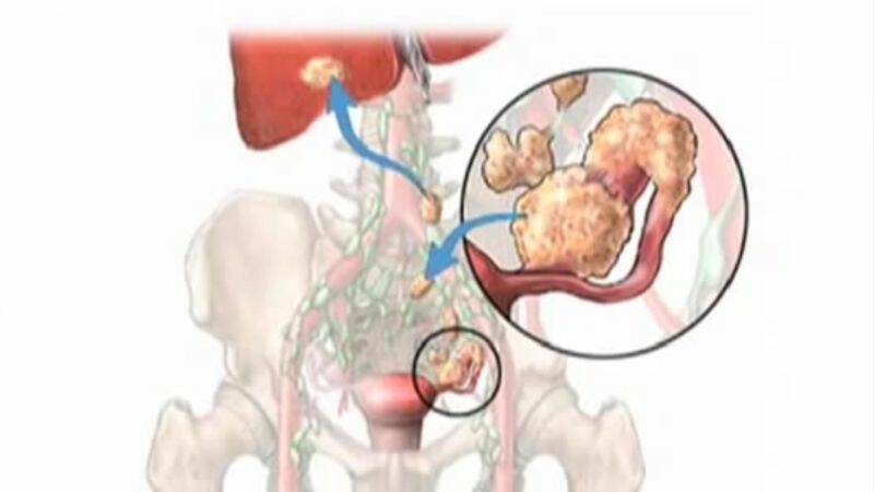 Chisturi pe ovare: este periculoasă ruptura? Și ce se întâmplă în timpul sarcinii?