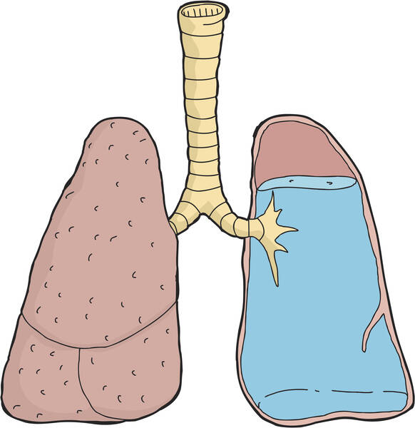 Edemul pulmonar: De ce apare edemul pulmonar? Este o cauză frecventă de deces?