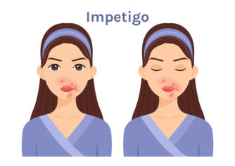 Ce este impetigo, ce simptome are? Infecțiozitatea și transmiterea la copii