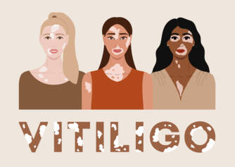 Vitiligo: Ce este vitiligo și care sunt cauzele și simptomele sale? Când începe?