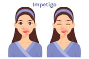 Ce este impetigo, ce simptome are? Infecțiozitatea și transmiterea la copii