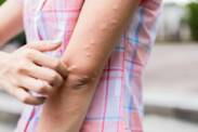 Urticaria: Urticaria nu numai după o arsură de urzică? Înseamnă o boală?